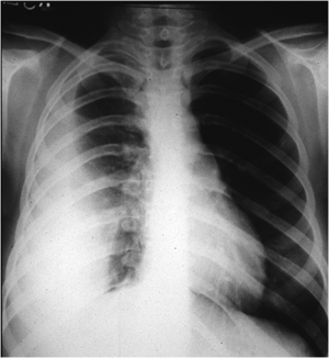 chest x ray