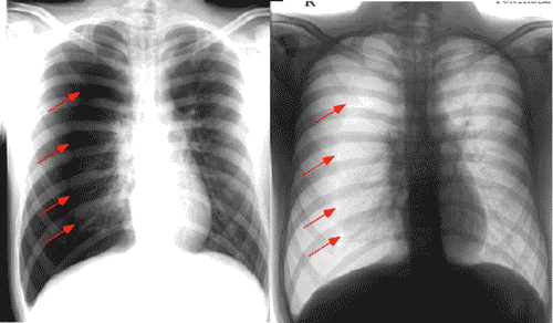 spontaneous pneumothorax