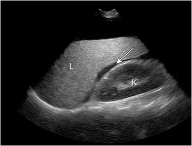 normal liver scan