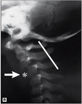 c2 and c3 xray image