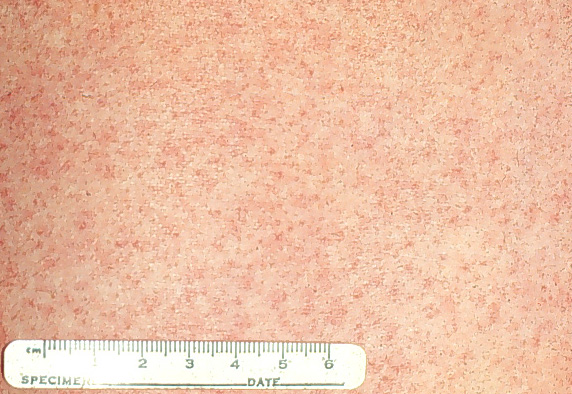 rash